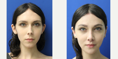 18-24 year old woman treated with Facial Feminization Surgery - 18-24 year old woman treated with Facial Feminization Surgery