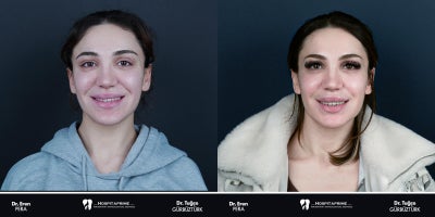 25-34 year old woman treated with Jaw Surgery, Genioplasty, V Line Surgery - Double jaw surgery is performed to correct the misalignment between the upper and lower jaws, balance facial aesthetics, and address functional issues such as chewing and speaking difficulties. The remarkable aesthetic and functional transformation of our patient once again proves the importance of meticulous planning and expert execution.