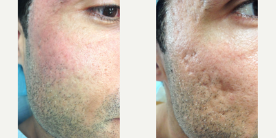 Man treated with MiXto Laser, Venus Viva - Details - Acne treated with lasers and fillers