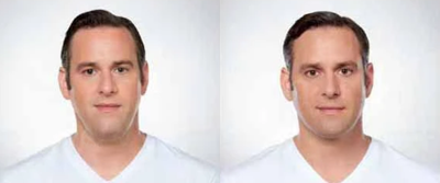 Man treated with Kybella - Man treated with Kybella to chin area, shown before and after 3 treatments.