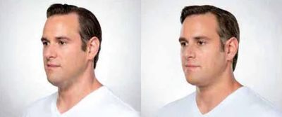 Man treated with Kybella - Man treated with Kybella to chin area, shown before and after 3 treatments.
