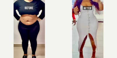 35-44 year old woman treated with Liposuction, BodyTite - 35-44 year old woman treated with Liposuction, BodyTite