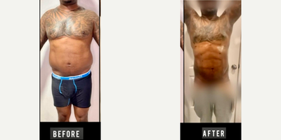 35-44 year old man treated with Abdominal Etching - 35-44 year old man treated with Abdominal Etching, HD LIPOSUCTION SPARTAN SHAPE
