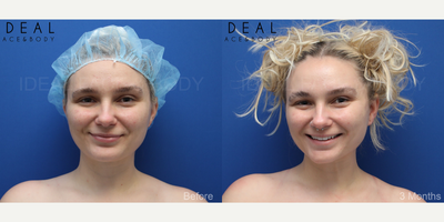 25-34 year old woman treated with Chin Liposuction, Laser Liposuction, Liposuction, Liposculpture, Tumescent Liposuction, Renuvi - We love her. Shes super cool, chill, confident, smart, easy to talk to, has great hair, and is SNATCHED! Were so happy for her after undergoing chin, neck, and jawline PRECISION SCULPT liposculpting.