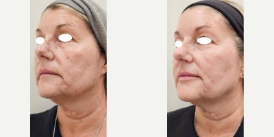 55-64 year old woman treated with IPL, Sylfirm X, Lip Fillers, Ultherapy, Alastin Skincare, Dysport - She started her Beauty Journey on January 31st 2024. She wanted to improve her skin quality in a natural and less invasive way. Her neck was a priority.We started with Ultherapy, 3 combined lasers (IPL plus vascular), Dysport, lip filler and then 3 SylfirmX face and neck treatments. She is using Alastin skincare