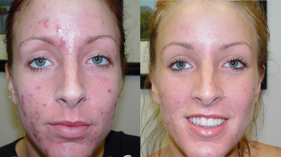 Acne patient treated with laser to clear her acne - Isolaz and Smoothbeam lasers can be used to treat acne as effectively as Accutane