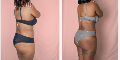 35-44 year old woman treated with Brazilian Butt Lift - This is a lovely patient underwent a 360 Liposuction and BBL, where fat was transferred to her buttocks and hips. She is shown 2 months post-op.