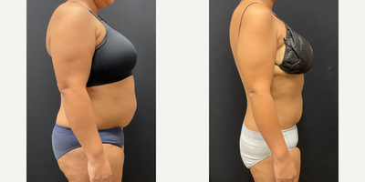 Woman treated with Semaglutide - Woman treated with Semaglutide