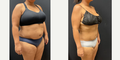 Woman treated with Semaglutide - Woman treated with Semaglutide