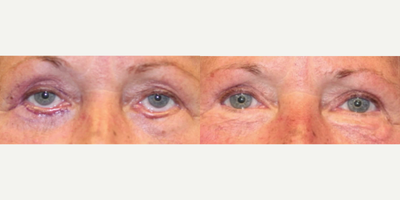 Eyelid retraction (pulled down lower eyelids) and ectropion (everted lower eyelids) revision surgery - Eye bag surgery, or lower eyelid blepharoplasty done by non-eyelid experts can not only pull the eyelids down when lower eyelid support structures are compromised, but can also cause ectropion, or the eversion of lower eyelids. Ectropion can cause irritation to the eyes, and compromise tear and tear film drainage. Restorative revision surgery is a complex procedure that involves anchoring the lower eyelids to bone for renewed support, and skin grafting or Enduragen use to restore lower eyelid skin.