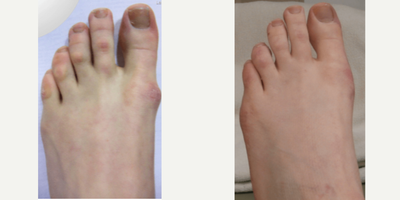 25-34 year old woman treated with Bunion Surgery - Left foot Bunion Correction