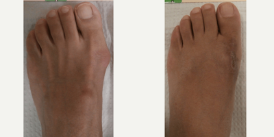 18-24 year old woman treated with Bunion Surgery - Left foot Bunion