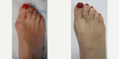 35-44 year old woman treated with Bunion Surgery - Right foot Bunion Correction