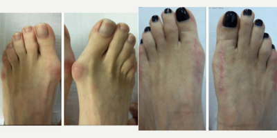 35-44 year old woman treated with Bunion Surgery - Both Right and Left foot Bunion Bunionectomy