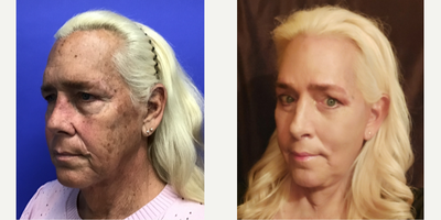 Patient treated with Transgender Facial Feminization Surgery, Facial Feminization Surgery, Cheek Lift, Cheek Augmentation, Volum - 55 to 64 year-old female patient is 3 months post-op from Facial Feminization surgery. Her procedures included: Forehead Lift, Hairline Lowering, Supra Orbital Bone Reduction and Contouring, Septorhinoplasty (closed) with Cartilage Grafts, Soft Tissue Malar Graft, Chin Reduction and Contour with Pre-Jowl Implant with Soft Tissue, Soft Tissue to Nasolabial Folds, Subnasal Lip Lift, Fat Augmentation to Lips, Thyroid Cartilage Shave and Voice Feminization, 180 Micrografts to the Fronto Temporal Recessions, Revision Upper and Lower Blepharoplasty, Deep Plane Facelift/Necklift, 2cc Voluma to Medial Cheeks and Deep Nasolabial Creases, 1cc Juvederm Bilaterally to the Perioral Rhytids, and Cheeklift.