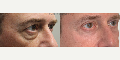 58 year old man treated with Laser Resurfacing - 58 year old man treated with 4 lid blepharoplasty and laser resurfacing of the lower lids.