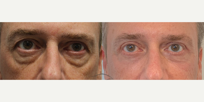 58 year old man treated with Laser Resurfacing - 58 year old man treated with 4 lid blepharoplasty and laser resurfacing of the lower lids.