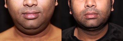 Laser Liposuction - Neck/Jowl - Laser Liposuction - Neck/Jowl