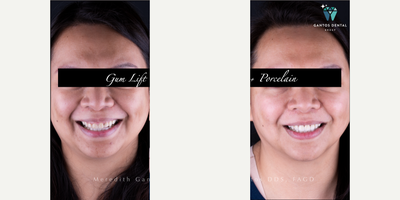 45-54 year old woman treated with Gum Lift - Gum lift + 4 Porcelain Veneers