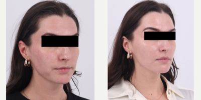 25-34 year old woman treated with Moxi, Microneedling RF - Before and after 1 session of RF Microneedling and Moxi