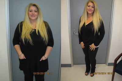 Sleeve Gastrectomy Before & After - 44 lbs lost in 3 months