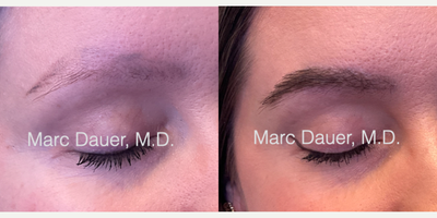 Woman treated with Eyebrow Transplant - Woman treated with Eyebrow Transplant