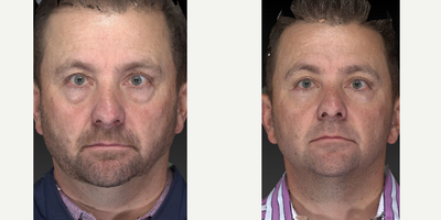 45-54 year old man treated with Eyelid Surgery - We are doing more and more cosmetic procedures on men. Everyone likes to look good!