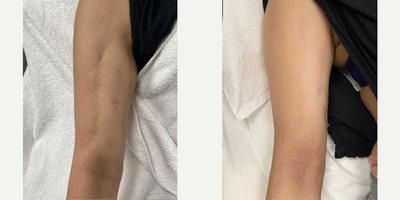 25-34 year old woman treated with Halo Laser, Potenza - One treatment of Potenza and two treatments of HALO performed at 8 West Clinic, Vancouver, BC.