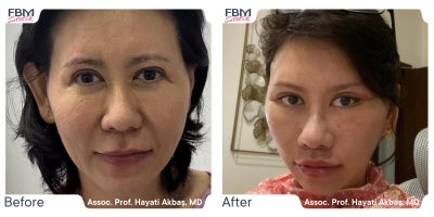 45-54 year old woman treated with Deep Plane Facelift, Facelift, Facial Fat Transfer, Eyelid Surgery - 45-54 year old woman treated with Deep Plane Facelift, Facelift, Facial Fat Transfer, Eyelid Surgery