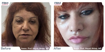 45-54 year old woman treated with Deep Plane Facelift, Facelift, Eyelid Surgery, Facial Fat Transfer, Lip Lift - 55-64 year old woman treated with Rhinoplasty, Facelift, Deep Plane Facelift, Facial Fat Transfer, Eyelid Surgery