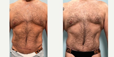 55-64 year old man treated with Tummy Tuck Revision - Male tummy tuck revision