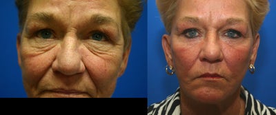 Revision facelift with lower lid blepharoplasty and lateral canthopexy - This 65-year-old woman had a previous facelift which she was unhappy with. The scars were visible and results were mediocre. I preformed a revision facelift with nearly invisible scarring as well as lower-lid blepharoplasty (lower-eyelids).
