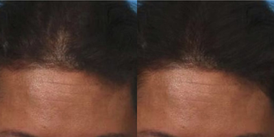35-44 year old woman treated with PRP for Hair Loss - 35-44 year old woman treated with PRP for Hair Loss