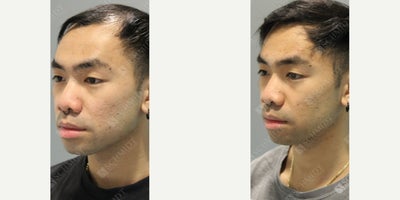 Man treated with NeoGraft - From thinning hair to complete confidence! This patients hair restoration journey began over 2 years ago when he decided to take control of his hair thinning with a personalized approach. During his first NeoGraft hair transplantation procedure, 2,500 grafts were strategically transplanted to the front, mid, and crown portions of the scalp. After seeing remarkable progress and regaining his confidence over the next year and 3 months, he returned for a second procedure to further increase his hair density in the frontotemporal, mid-scalp, and crown areas. I transplanted 3,000 grafts to these key regions this time without lowering his original hairline. Now, with a total of 5,500 grafts, his hair looks thicker, healthier, and completely natural. His story is an inspiration for anyone considering a multi-step approach to hair restoration!