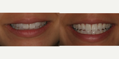 25-34 year old woman treated with Clear Braces - 8 months treatment time with Invisalgin