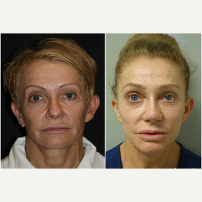 55-64 year old woman treated with Revision Rhinoplasty - This woman who also had secondary facelift/rhytidoplasty, had 7 past nosejobs and didn't like her amorphous and bulbous appearance. Using ear cartilage with an open technique, Dr Haworth was able to restore some elegance to her nose.