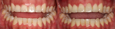 25-34 year old woman treated with Gum Lift - Patient has a gummy smile and wanted longer teeth. The doctor evaluated patient and stated that she's a good candidate for a gum lift.