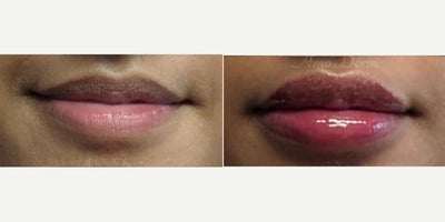 18-24 year old woman treated with Juvederm, Lip Fillers, Restylane Kysse, Volbella - Lip augmentation with hyaluronic acid filler (Juvederm, Vollure, Volbella, Voluma, Restylane or Belotero) for balanced natural look & pout