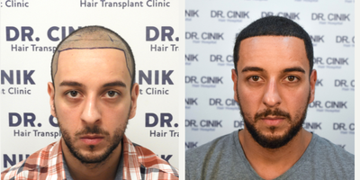 25-34 year old man treated with FUE Hair Transplant - He had two operations to get the best resultFirst operation date: 04/11/20185000 Total GraftsSecond operation date: 04/26/20192900 Total Grafts