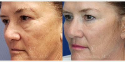 Woman treated with Eyelid Surgery - Woman treated with Eyelid Surgery