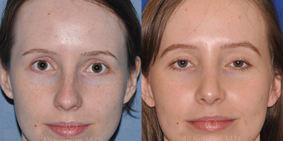 Woman treated with Rhinoplasty - Woman treated with Rhinoplasty