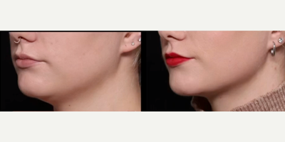 Woman treated with Chin Liposuction -  Chin Vaser Lipo 2 months post-op & looking snatched!