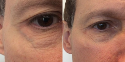 large vein of lower eyelid elimated with Excel V, 3months after second treatment - Excel V laser eliminated without scarring this large blue vein that he had since 25 years old. No surgery, no injections.