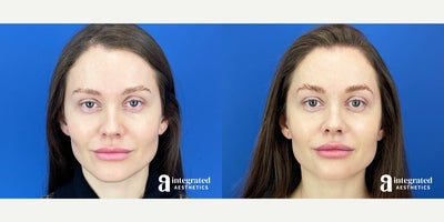 35-44 year old woman treated with Sculptra - The patient is a 39-year-old female with concerns about facial aging in the midface and jowls. To address these concerns, Dr. Climov treated these areas with Sculptra. The after results are 2 months post-treatment.