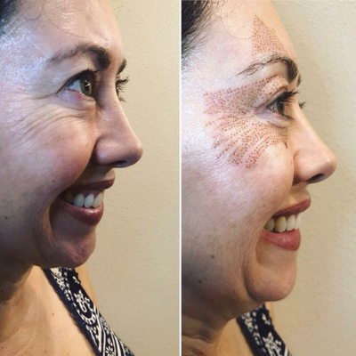 55-64 year old woman treated with Laser Treatment - Plasma Fibroblast Crows Feet post treatment