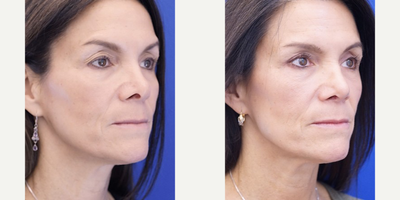 45-54 year old woman treated with Revision Rhinoplasty - She has undergone 3 nasal surgeries and the un-natural appearance of the nasal tip deformity is evident.Open revision tip surgery restores proper tip projection and nostril shape and proportion.