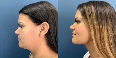 25-34 year old woman treated with Nonsurgical MyEllevate Neck Lift with SmartLipo - This 33-year-old presented with neck laxity and desired a more defined neck and jawline. The doctor performed a non-surgical neck lift using the MyEllevate suture technique in combination with SmartLipo.