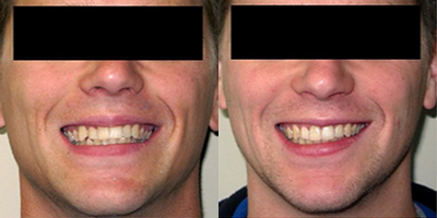 Invisalign - Invisalign