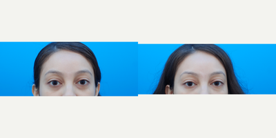 18-24 year old woman treated with RHA Collection Fillers  (Under eye) - Patient treated with RHA 2 for under eye filler/ tear trough
