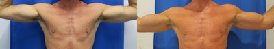 Man treated with Bicep Implants - Man treated with Bicep Implants